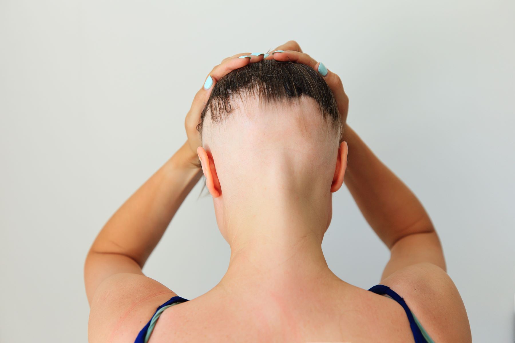 Woman with alopecia areata