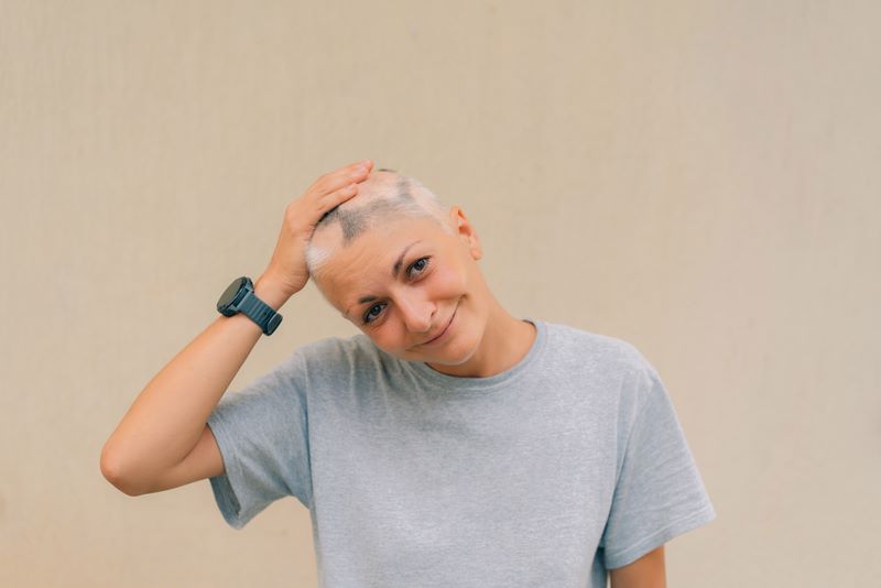 Woman with alopecia areata smiling