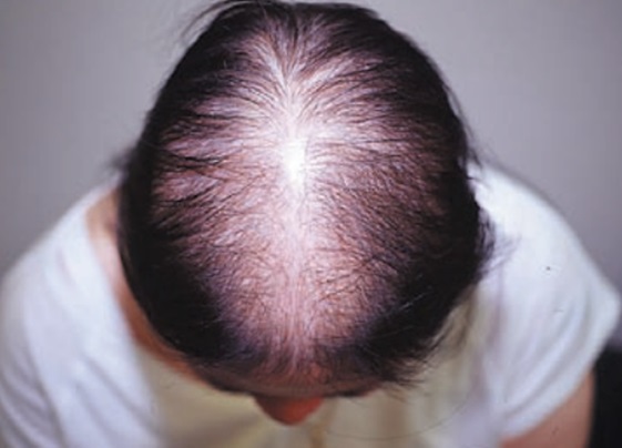 Woman with female pattern hair loss