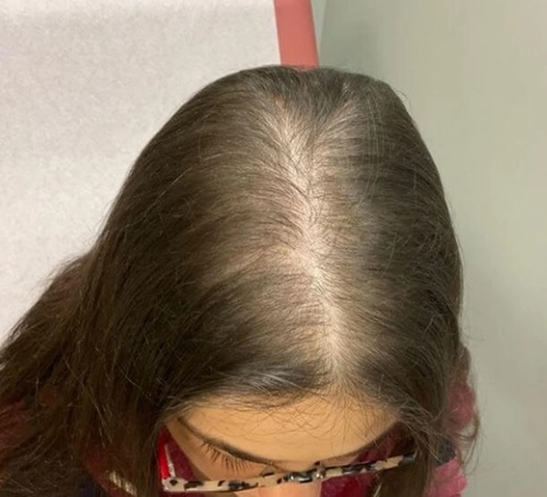 Woman with thyroid hair loss