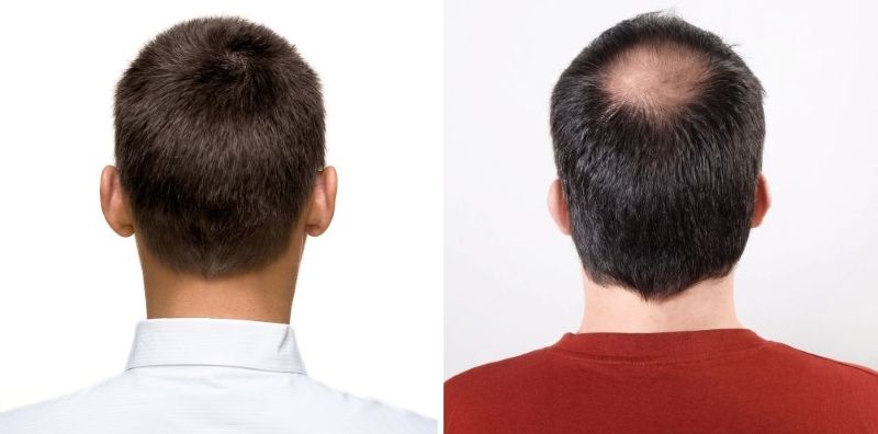 crown vs crown balding