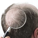 Double Crown Vs Balding: Differences, Symptoms, Treatments
