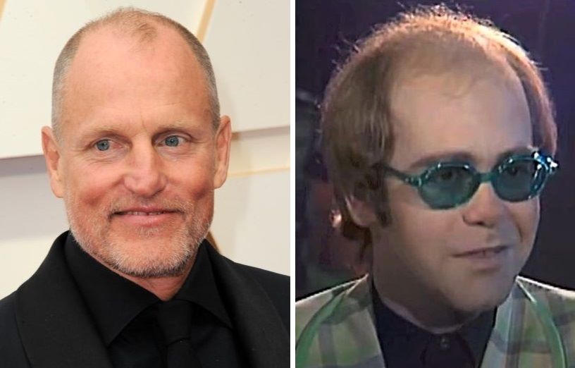 Celebrity examples of Norwood stage 5 hair loss