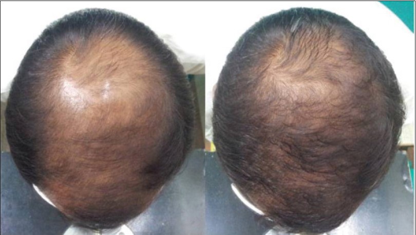 before and after hair growth results from using Dutasteride to treat male pattern baldness
