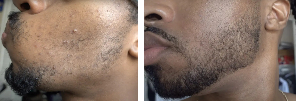 Beard hair growth before and 6 months after Minoxidil treatment