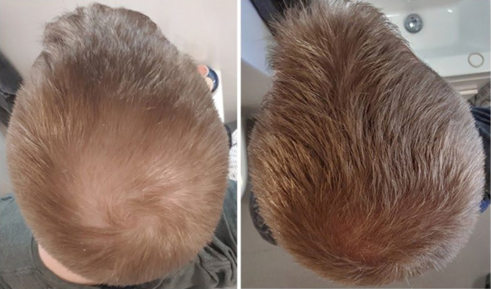 Before and after results of using Finasteride for male hair loss