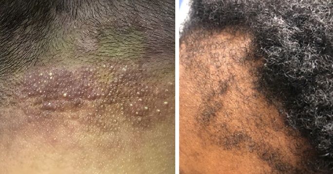 Folliculitis on the hairline (left) and patient with traction alopecia (right)