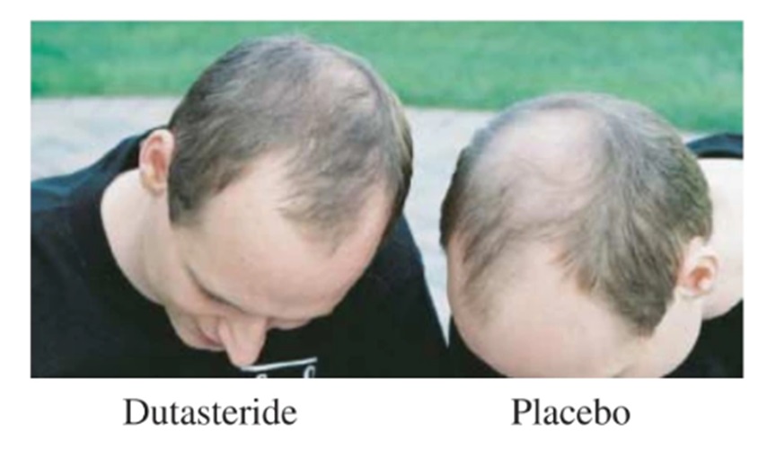 Hair growth in twins treated with Finasteride and placebo