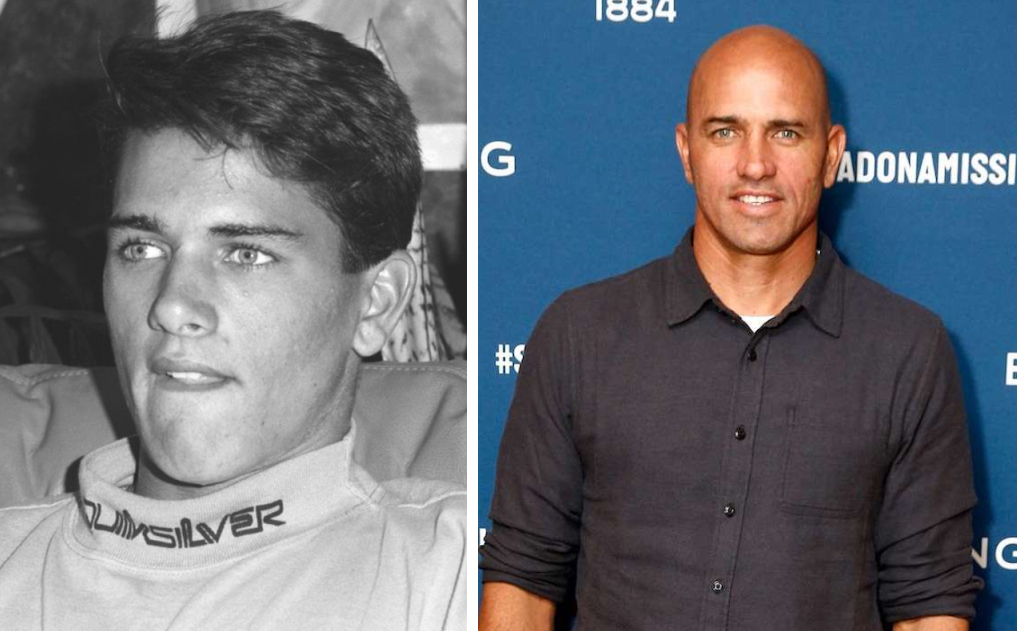 Young Kelly Slater with hair (left) and bald (right)