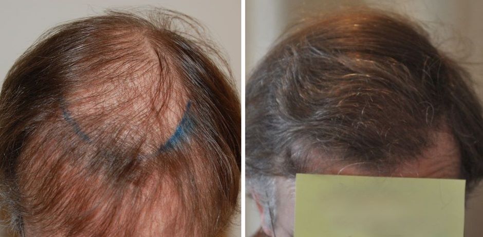 Man before and after a hair transplant at the Wimpole Clinic