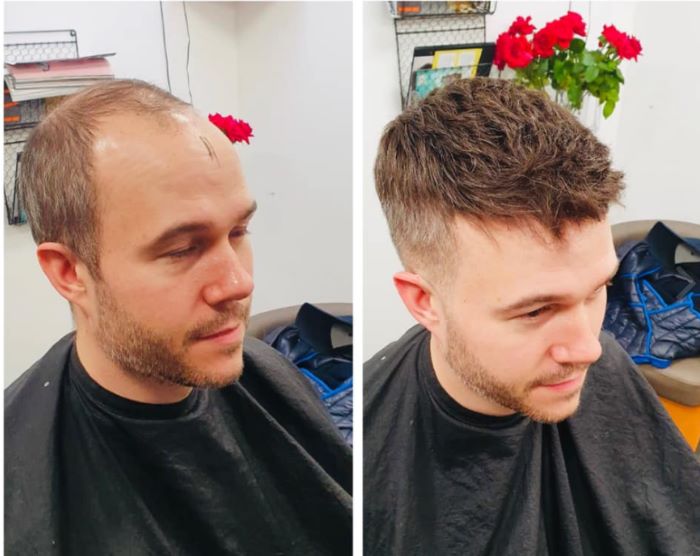 Man before and after wearing a hair system