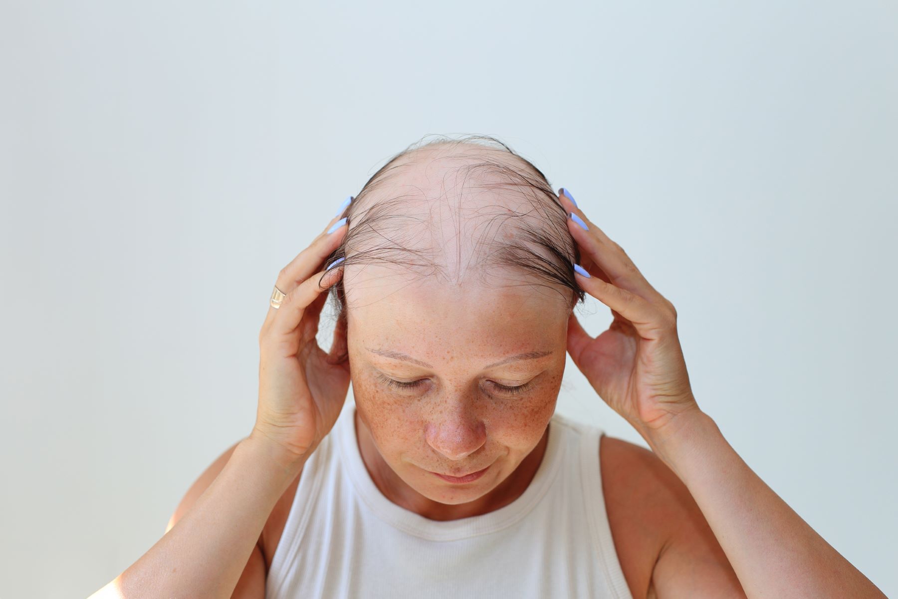 Medication-induced hair loss