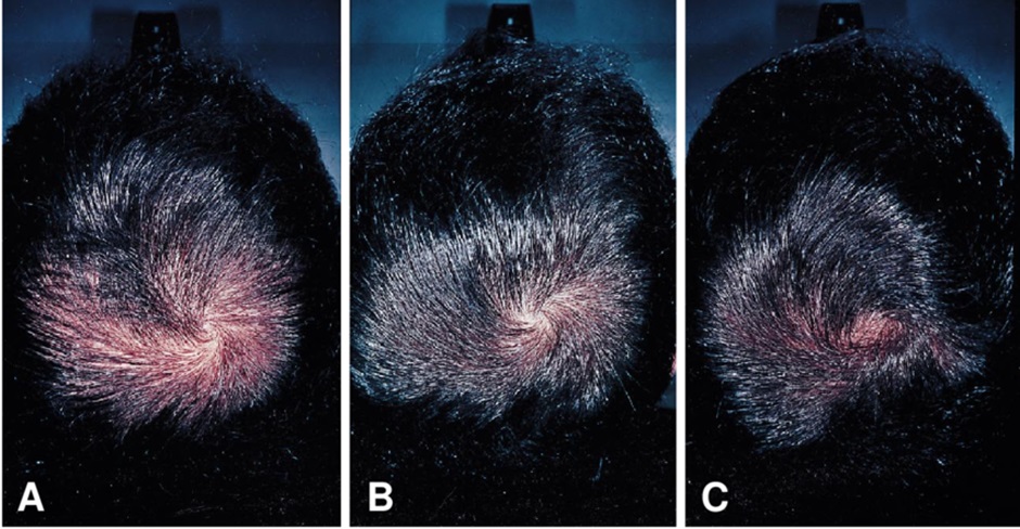Patient before and after Finasteride treatment