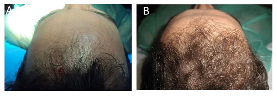 Patient before and after PRP treatment