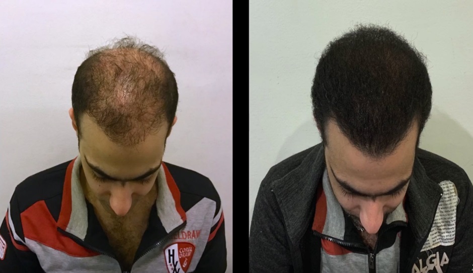 Patient before and after his hair transplant