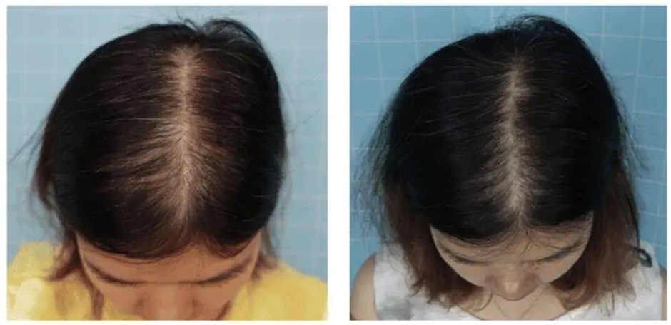 Woman’s hair before and after 6 months of daily Minoxidil treatment