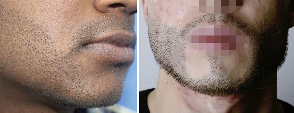 cobblestoning and scarring at the hair transplant recipient site