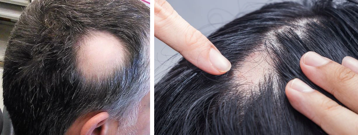 Examples of Alopecia Areata on the scalp