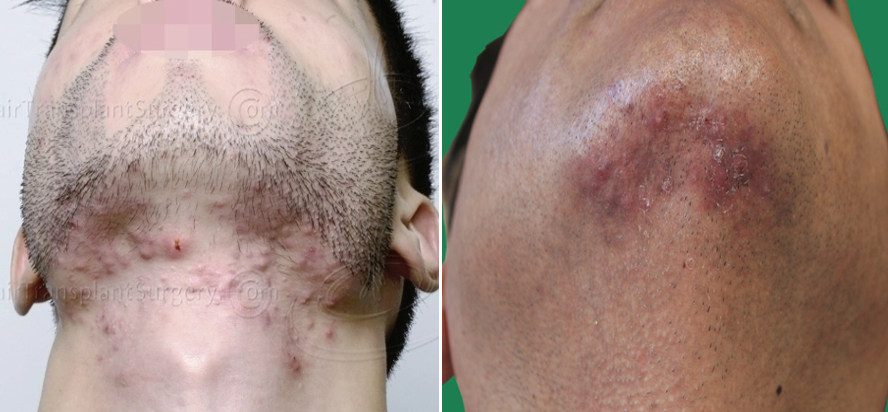 examples of folliculitis on the chin and neck following beard hair transplant surgery