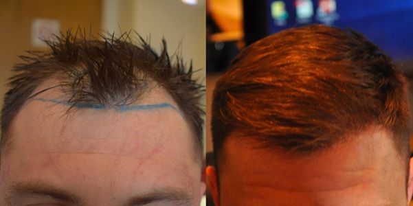 Are Hair Transplants Worth It? Key Factors Explained, Wimpole Clinic