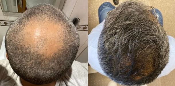 Are Hair Transplants Worth It? Key Factors Explained, Wimpole Clinic