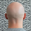 8000 Grafts Hair Transplant: Coverage, Results, Costs