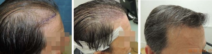 Before UFUE (left), immediately after UFUE (centre) and the results of a UFUE hair transplant (right)