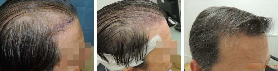 Patient before UFUE (left), immediately after UFUE (centre), and the results of an UFUE hair transplant (right)