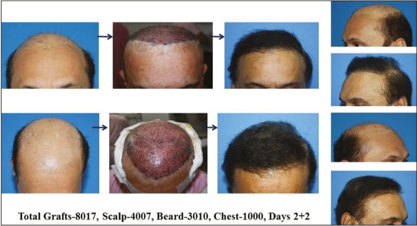 Before and after 8000 grafts hair transplant