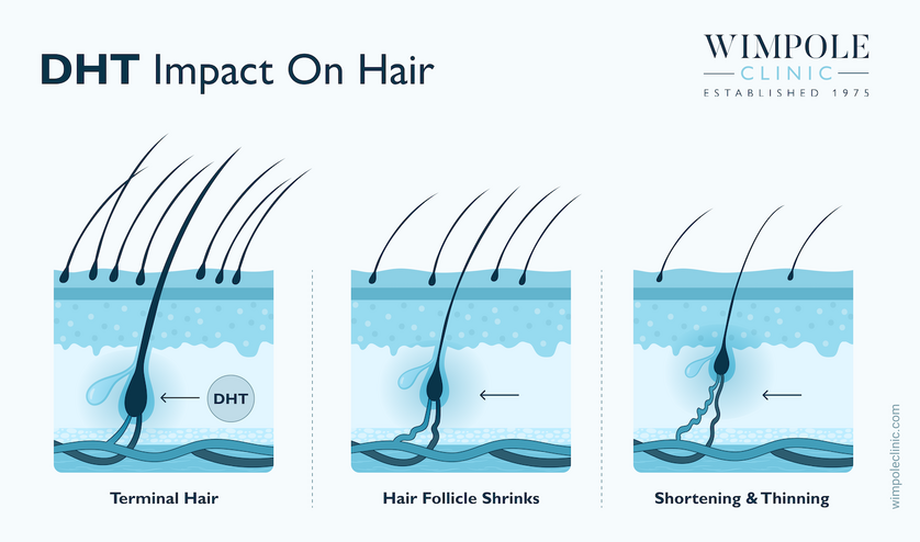 Hair Anatomy, Hair Diagrams and The Mechanisms of Hair Loss