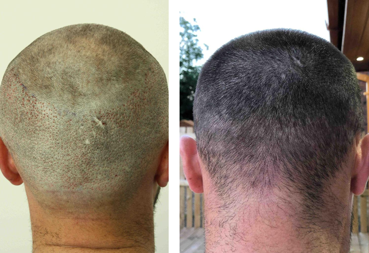 Donor area on the day of surgery (left) and 2 weeks after hair transplant (right)