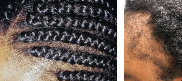 Examples of hair loss from traction alopecia