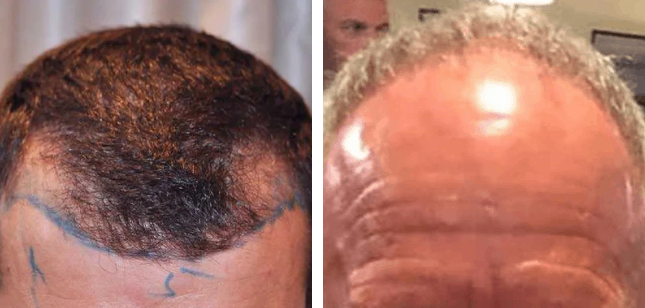 Examples of receding hairlines caused by male pattern hair loss