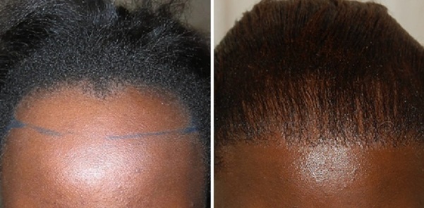 Female patient before and 12 months after 2000 grafts afro hair transplant