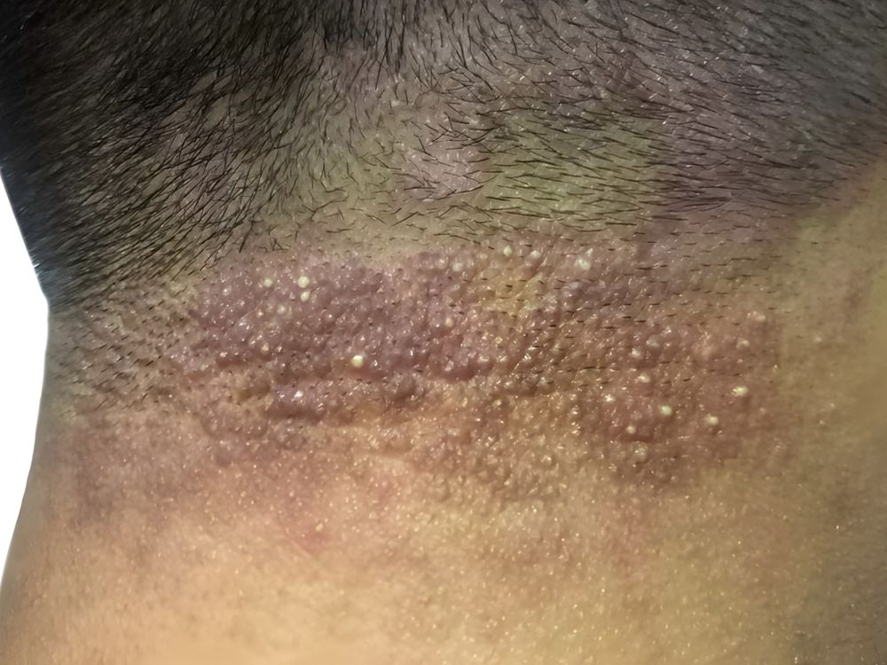 Folliculitis pustules