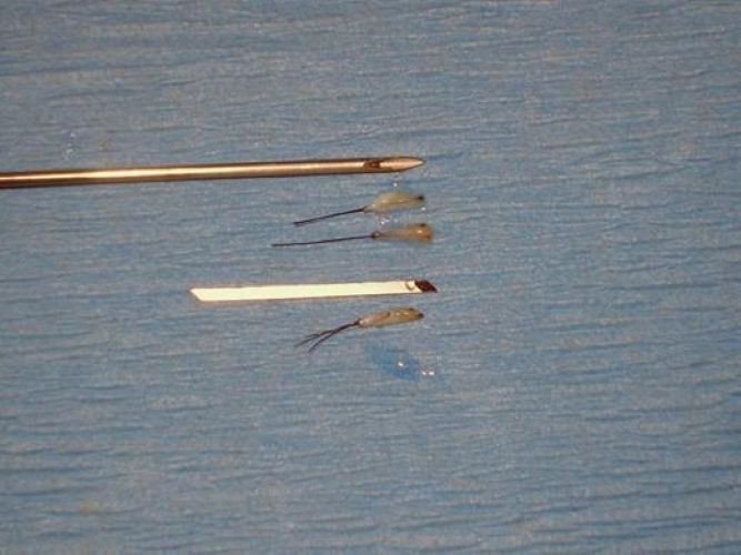 Hair grafts taken during a FUE hair transplant procedure