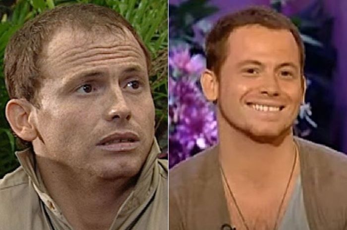 Joe Swash before and after first hair transplant