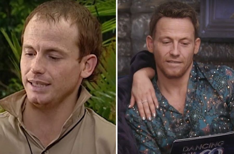 Joe Swash before and after hair transplants