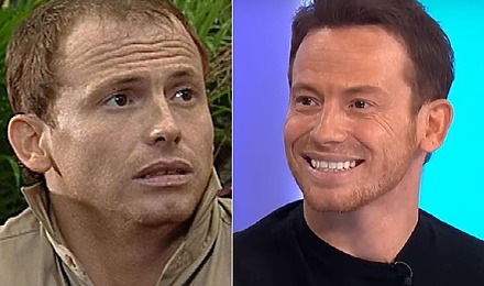 Joe Swash Hair Transplant