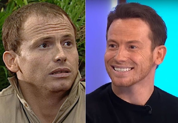 Joe Swash Hair Transplant