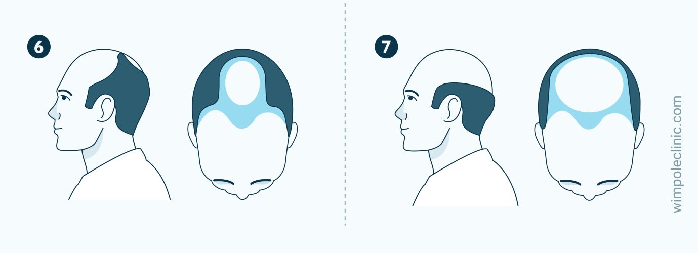 Norwood stages 6 and 7