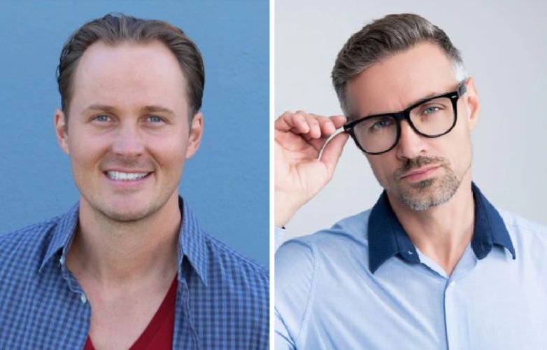 Receding hairline vs mature hairline