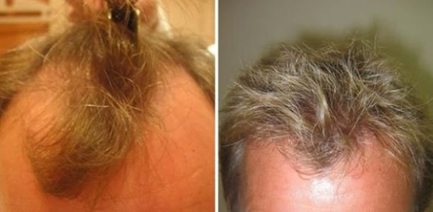 Wimpole patient before and 7 months after 900 grafts FUT hair transplant