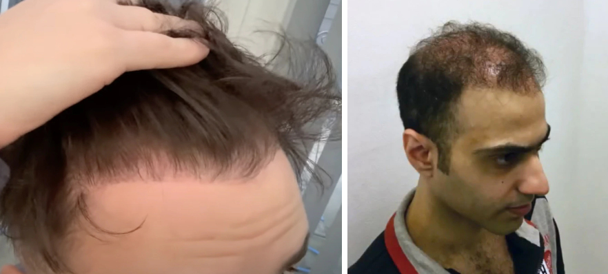 limited hair growth on receding hairlines after hair transplant surgery