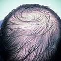 My Hair Is So Thin I Can See My Scalp: What Should You Do?