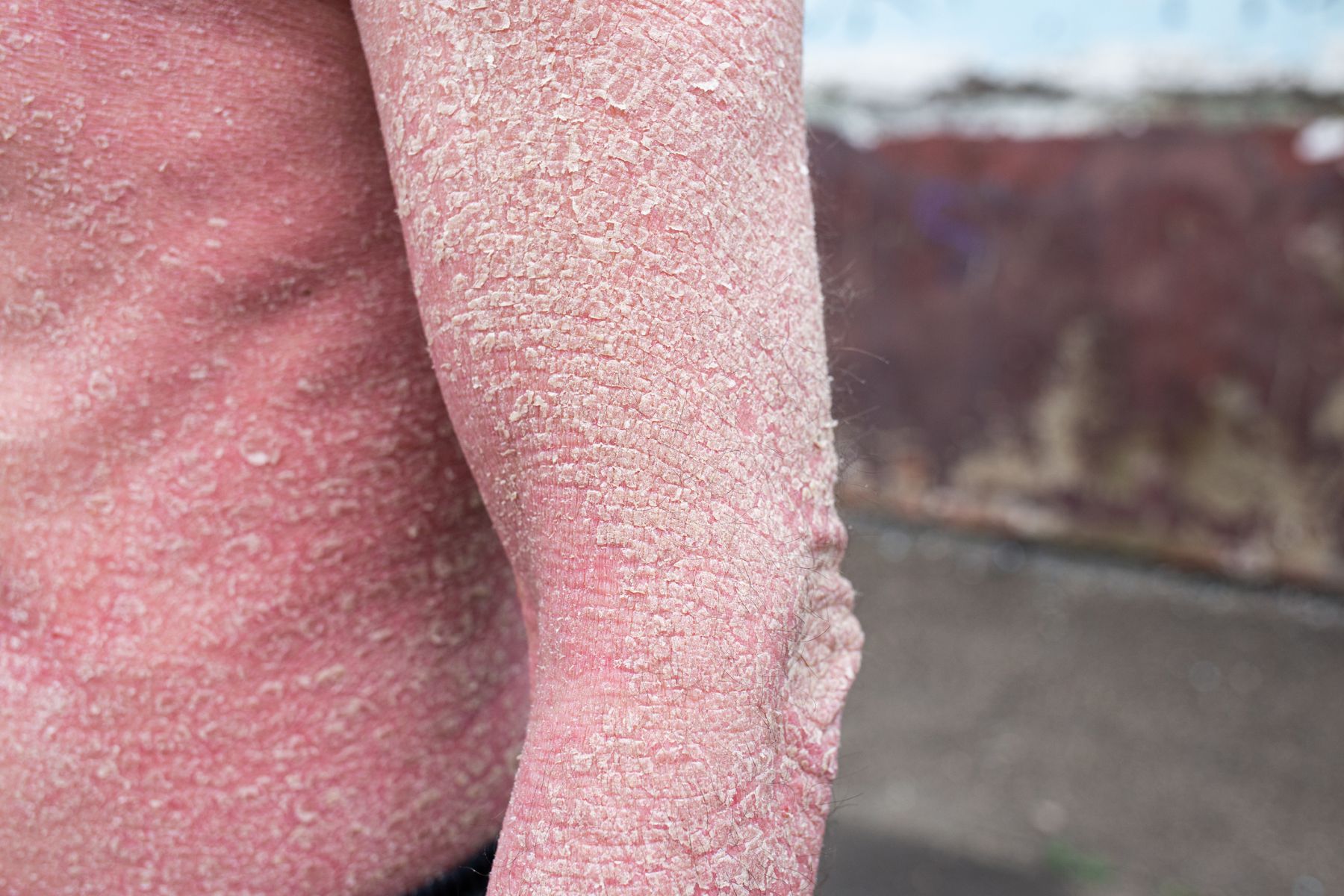 Widespread psoriasis on arm and torso