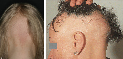 alopecia ophiasis