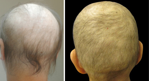 chemotherapy induced alopecia
