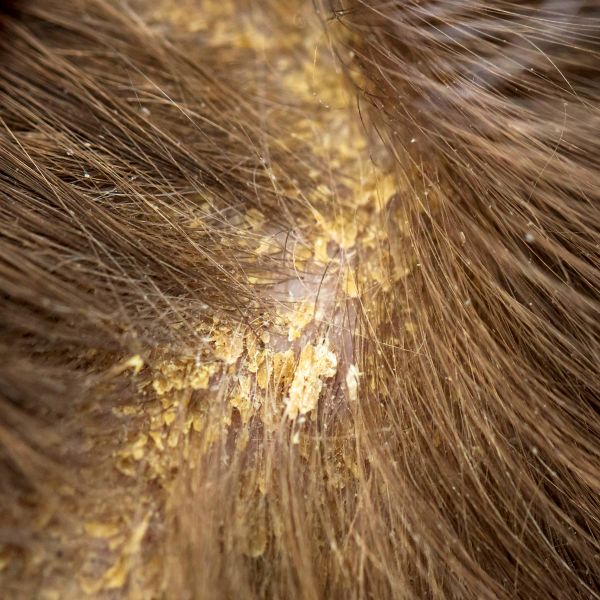 fungal dandruff (seborrheic dermatitis)