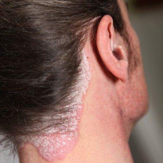 psoriasis behind the ears